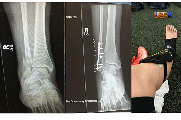 x-ray of broken leg